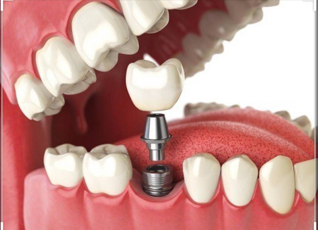 dental-implantation- صورة المقال